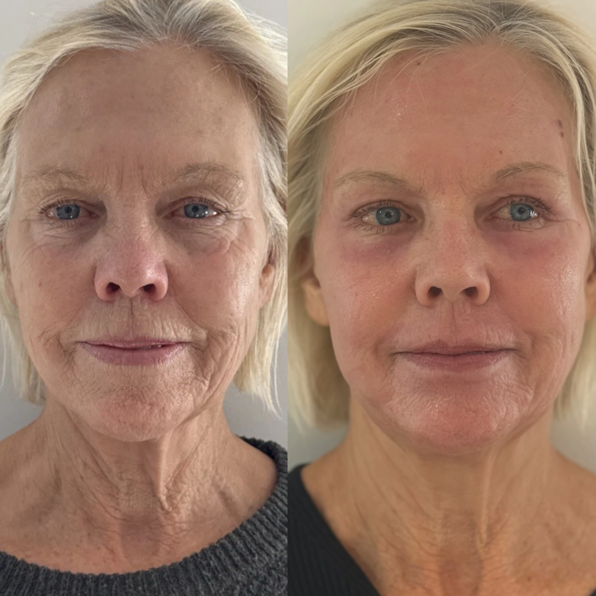 skinmeghandinneen B&A - e